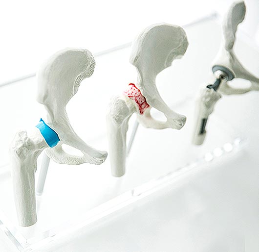 Der muskelschonende AMIS-Zugang (Anterior Minimally Invasive Surgery)