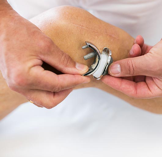 Nicht immer ist ein ganzes künstliches Knie erforderlich